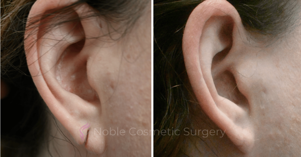 Earlobe Repair Case 20256