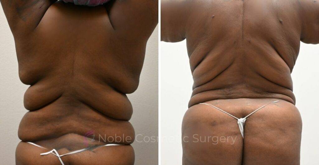 LIPOSUCTION CASE 14343