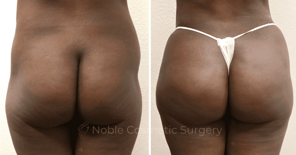 Brazilian Butt Lift Case 15104