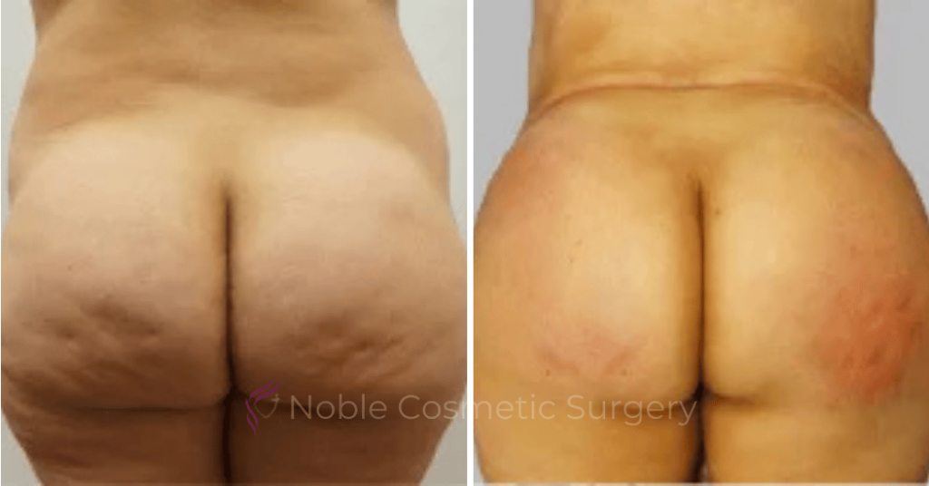 Brazilian Butt Lift Case 15106