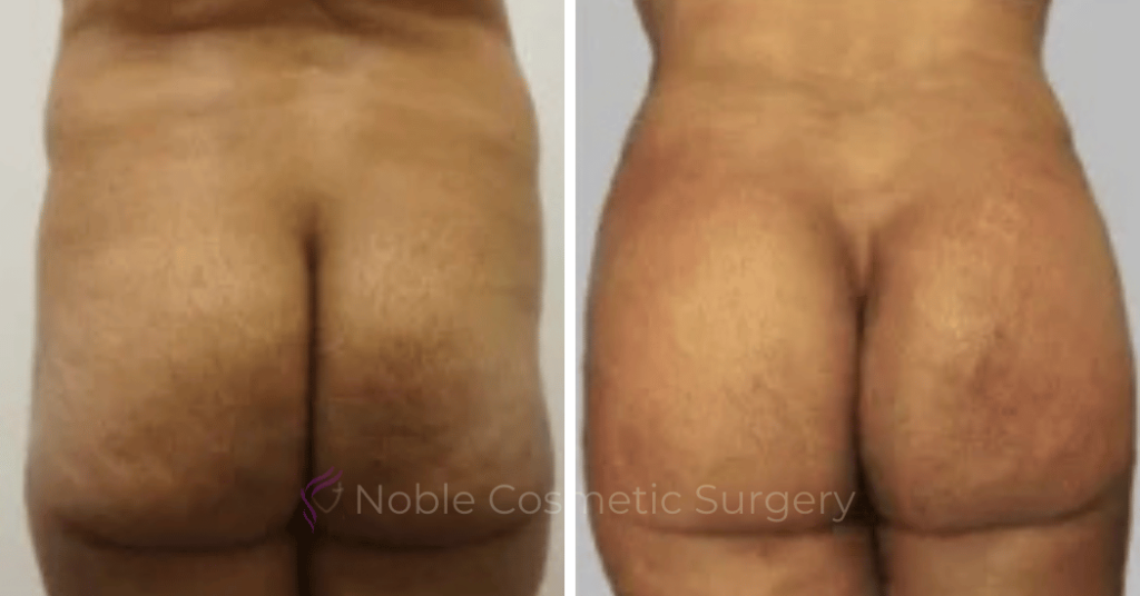 Brazilian Butt Lift Case 15113