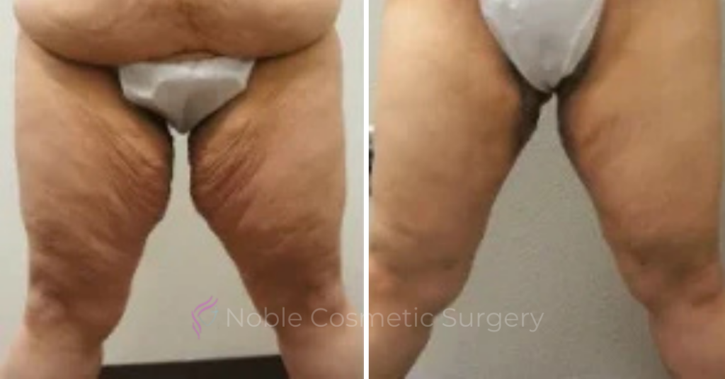 Thigh Lift Case 10386