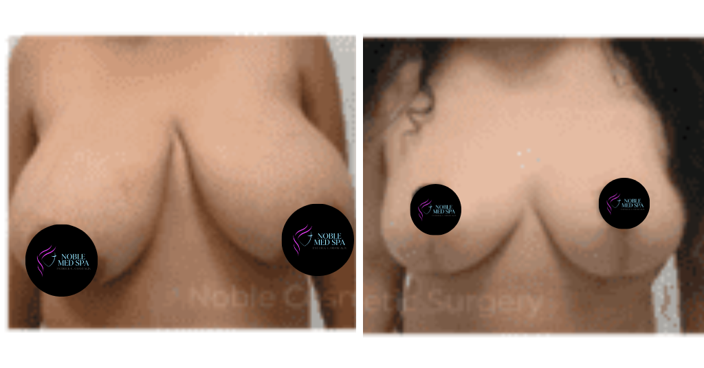 BREAST REDUCTION CASE 19221