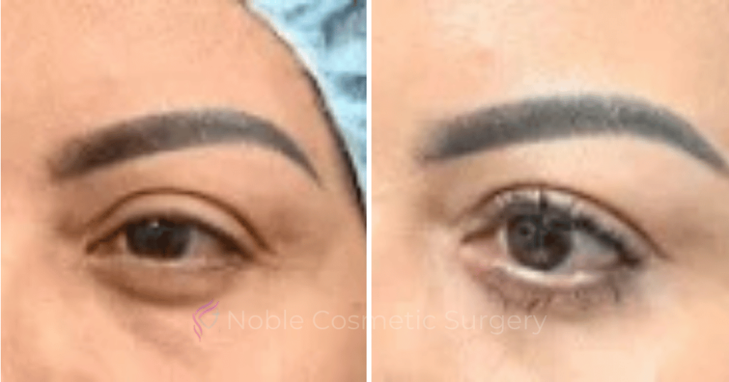 ​​Blepharoplasty Case 20260