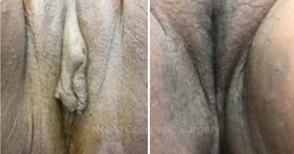 Labiaplasty Case 20266