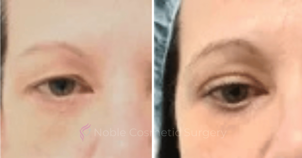 ​​Blepharoplasty Case 20259