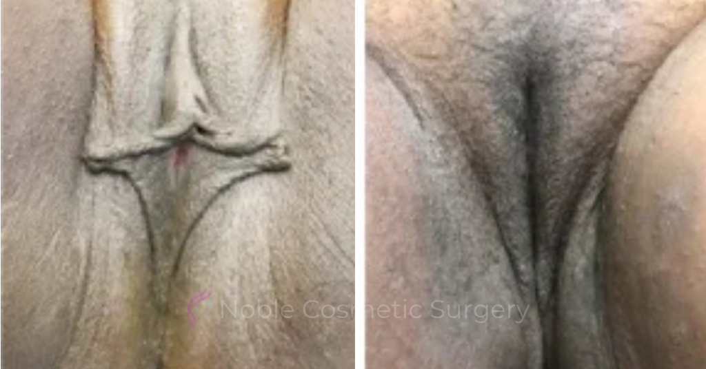 Labiaplasty Case 20265