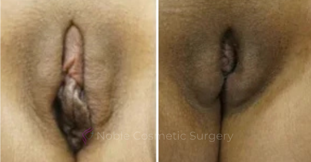 Labiaplasty Case 20264