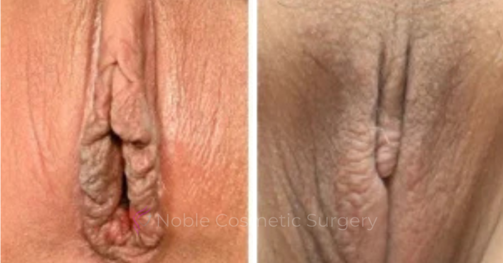 Labiaplasty Case 20262