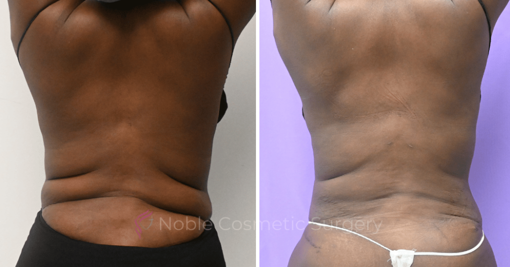 LIPOSUCTION ABDOMEN CASE 10414