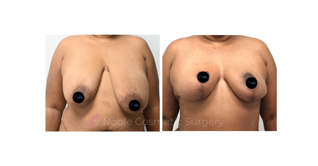 BREAST REDUCTION CASE 19222