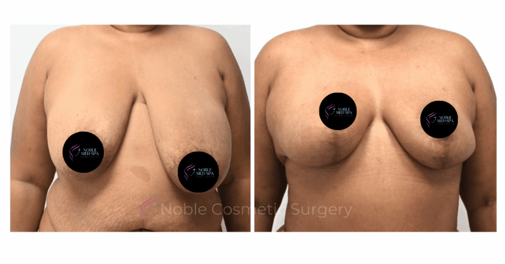 BREAST REDUCTION CASE 19222