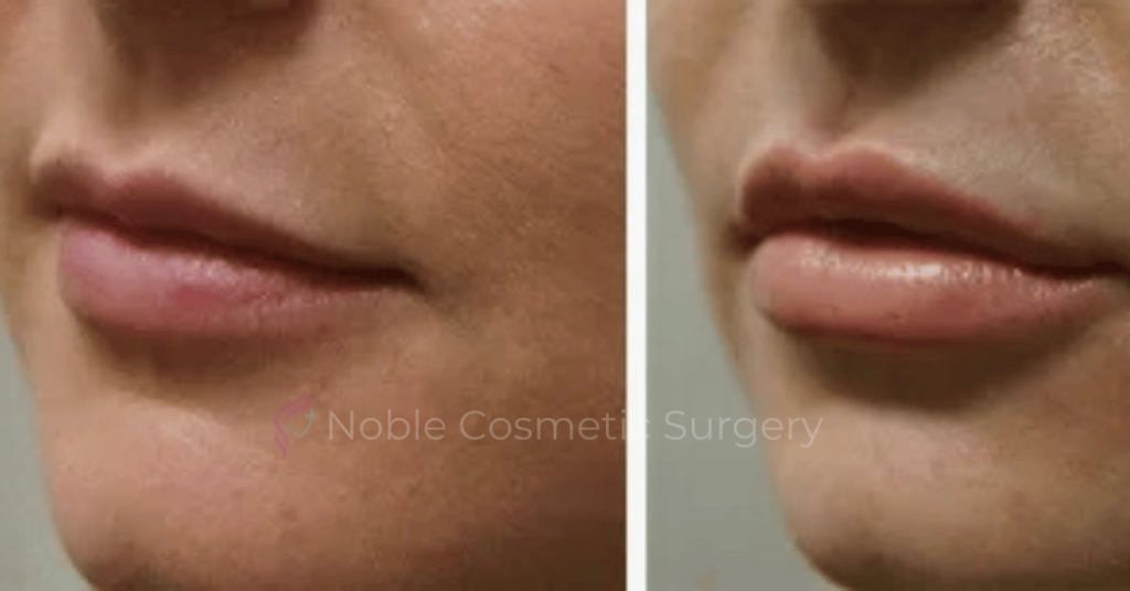 Dermal Fillers Case 00251