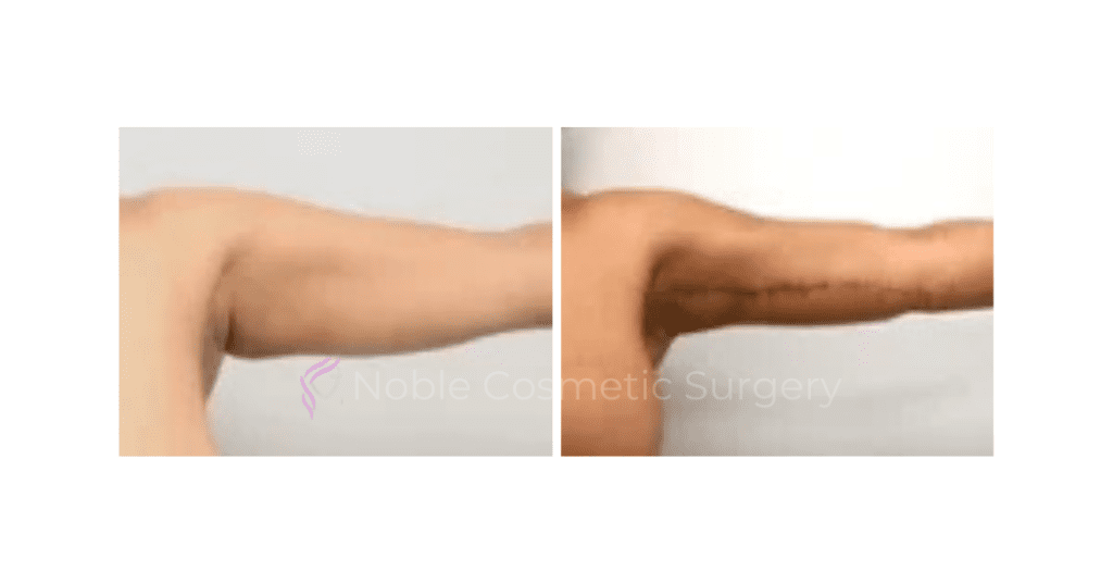 ARM LIFT CASE 00251
