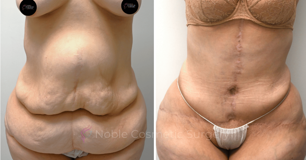 TUMMY TUCK CASE 10950