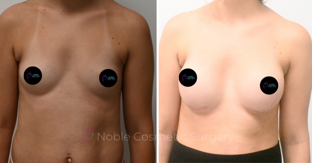 BREAST AUGMENTATION CASE 11094