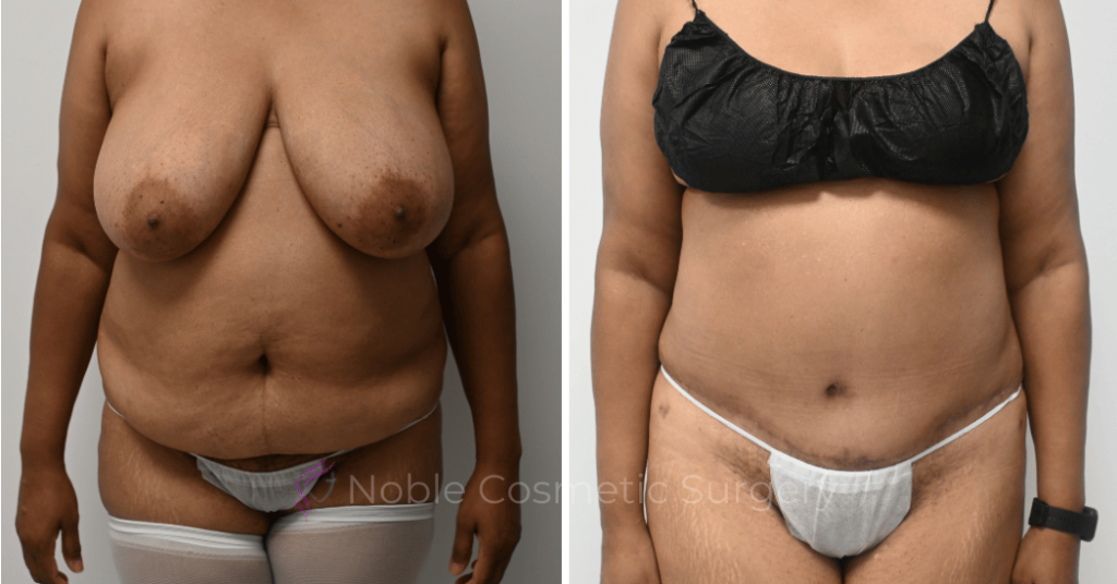 TUMMY TUCK CASE 11110