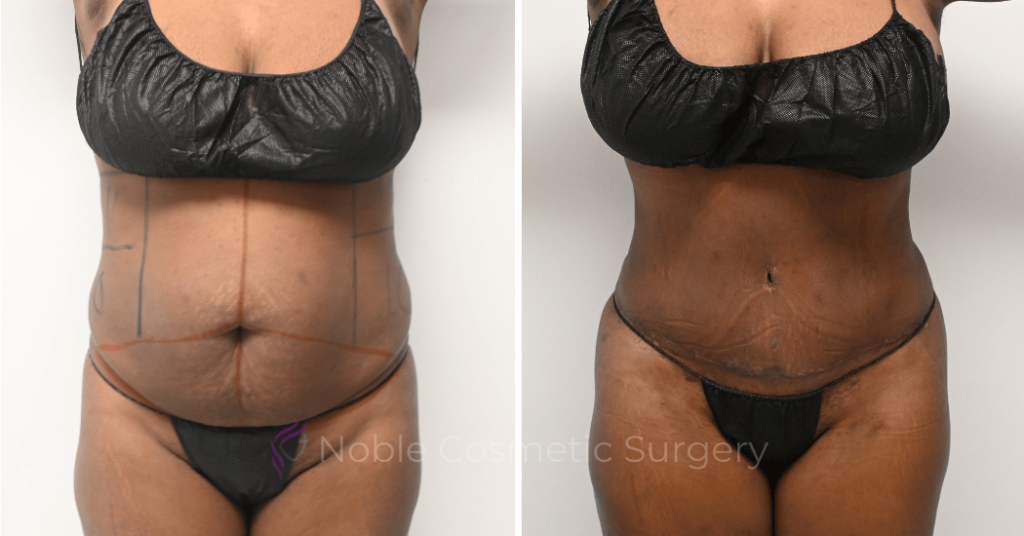 TUMMY TUCK CASE 11298