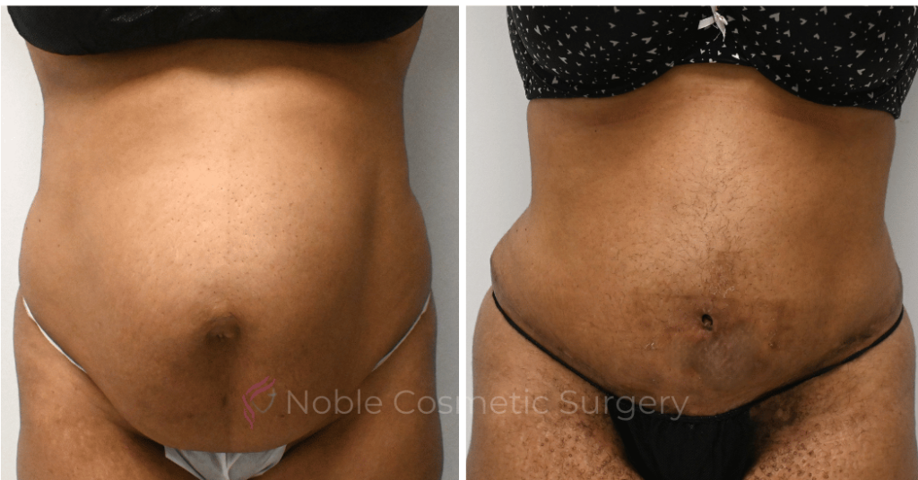 TUMMY TUCK CASE 11974