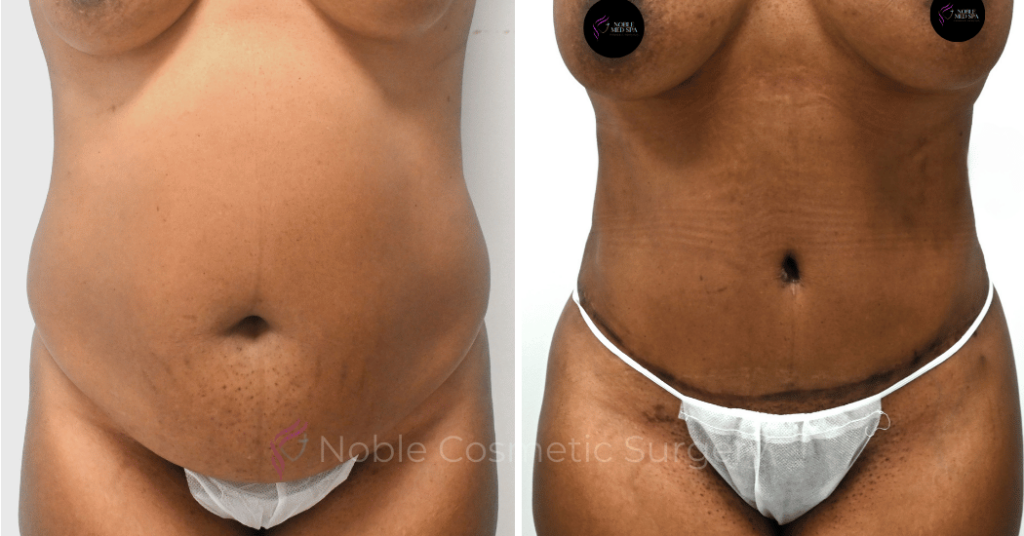 TUMMY TUCK CASE 12002