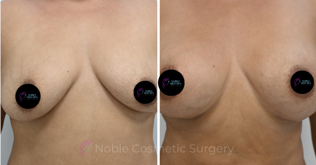 BREAST AUGMENTATION CASE 12466