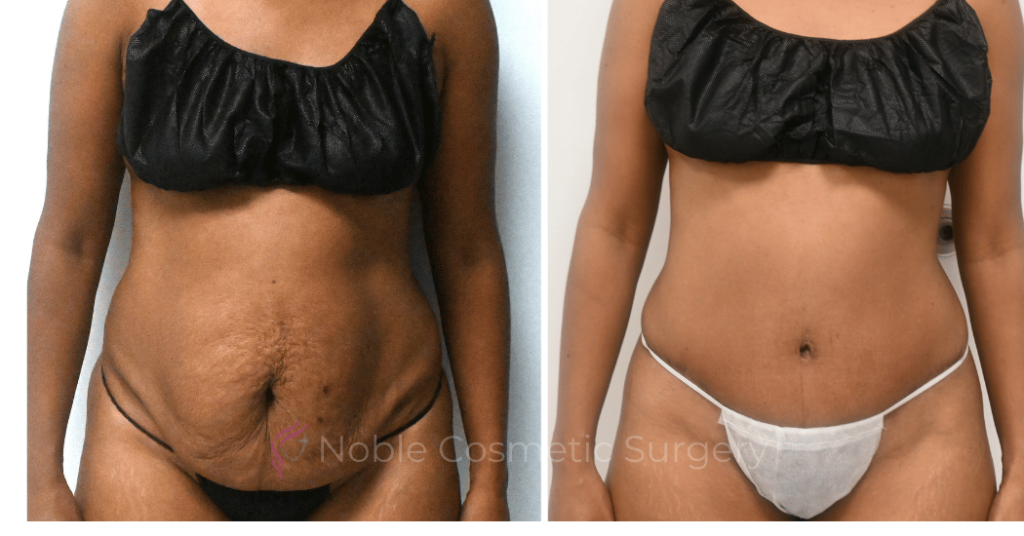 TUMMY TUCK CASE 12999