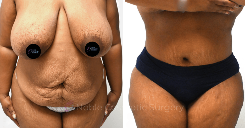 TUMMY TUCK CASE 14522