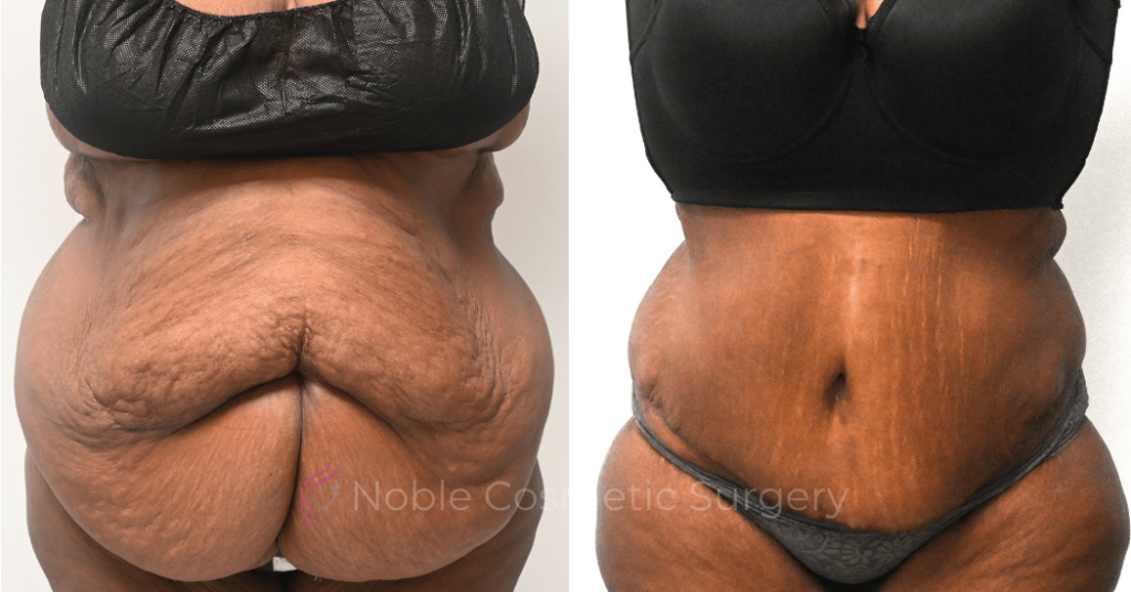 TUMMY TUCK CASE 14955