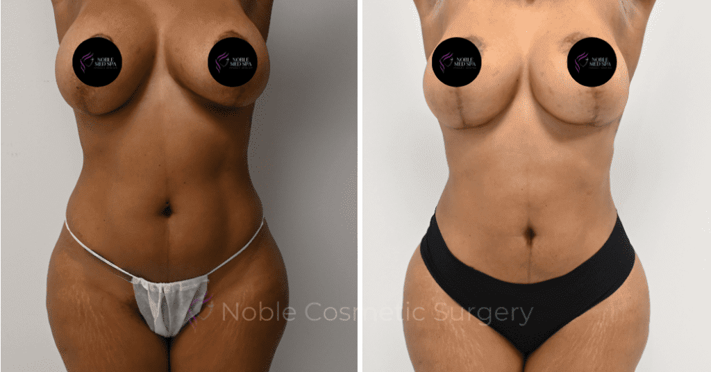 BREAST REDUCTION CASE 16458