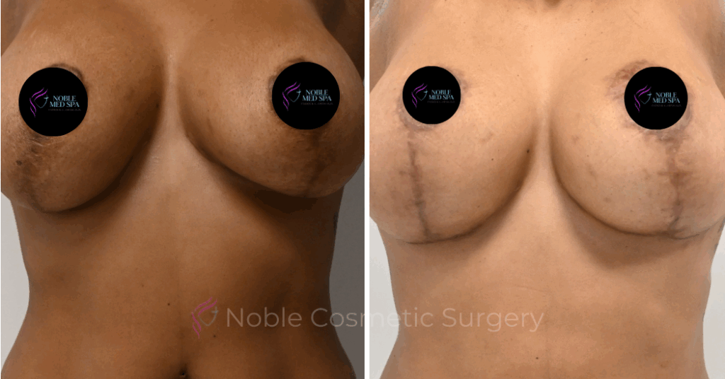 BREAST AUGMENTATION  WITH LIFT  CASE 16458
