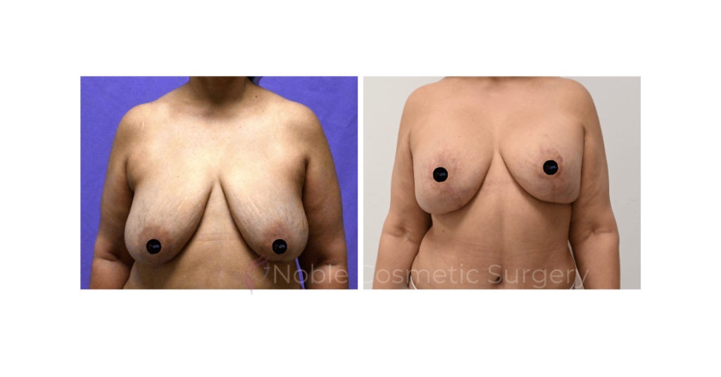 BREAST REDUCTION CASE 19220