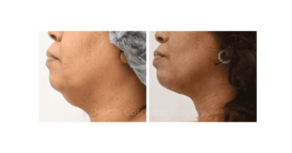 SUBMENTAL LIPOSUCTION (CHIN) CASE 19224