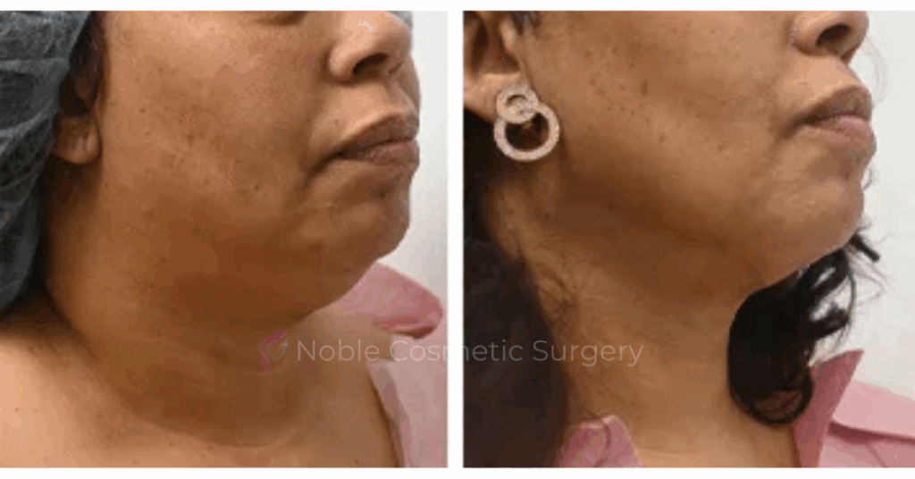 SUBMENTAL LIPOSUCTION (CHIN) CASE 19224