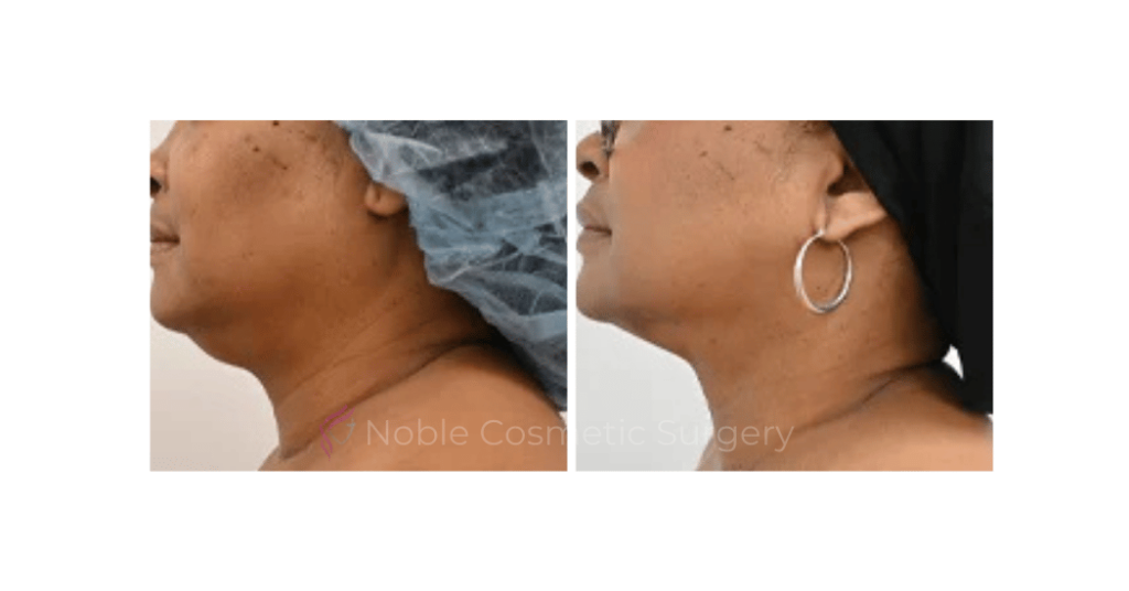 LIPOSUCTION SUBMENTAL (CHIN) CASE 19225