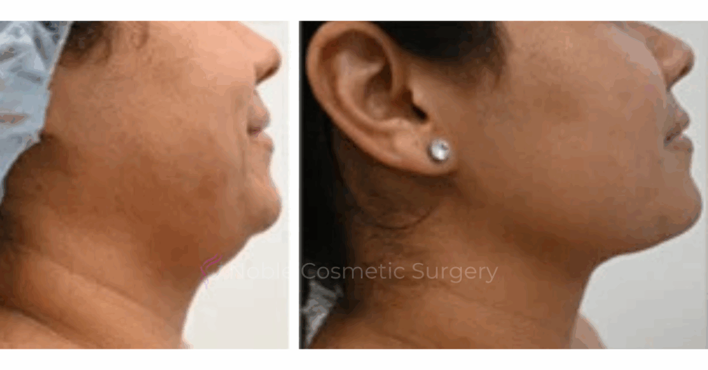 SUBMENTAL LIPOSUCTION (CHIN) CASE 19225
