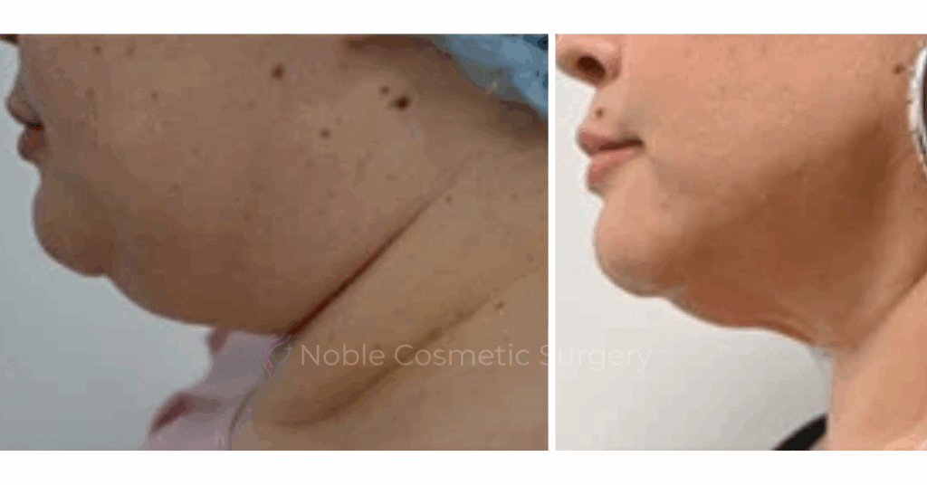 SUBMENTAL LIPOSUCTION (CHIN) CASE 19226