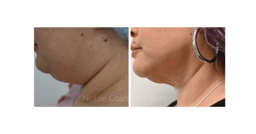 LIPOSUCTION SUBMENTAL (CHIN) CASE 19226