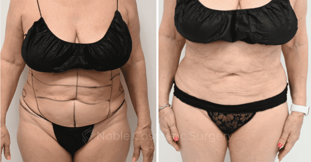 LIPOSUCTION CASE 10145