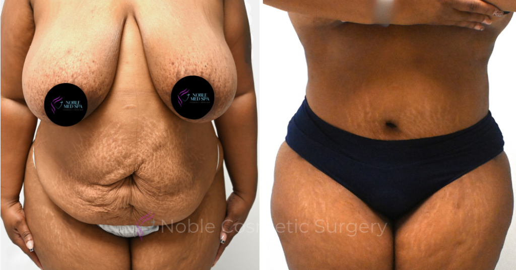 TUMMY TUCK CASE 14522