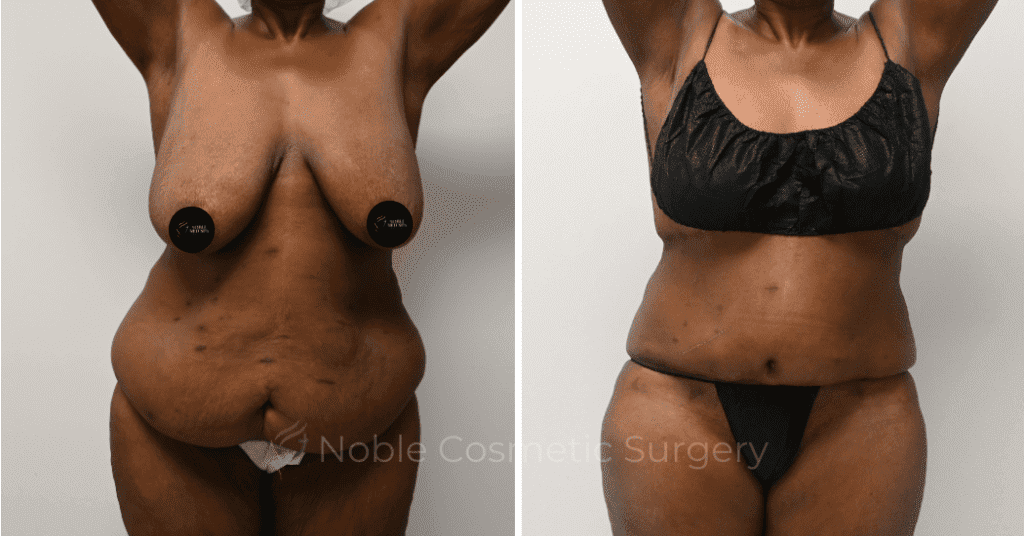 TUMMY TUCK CASE 11910