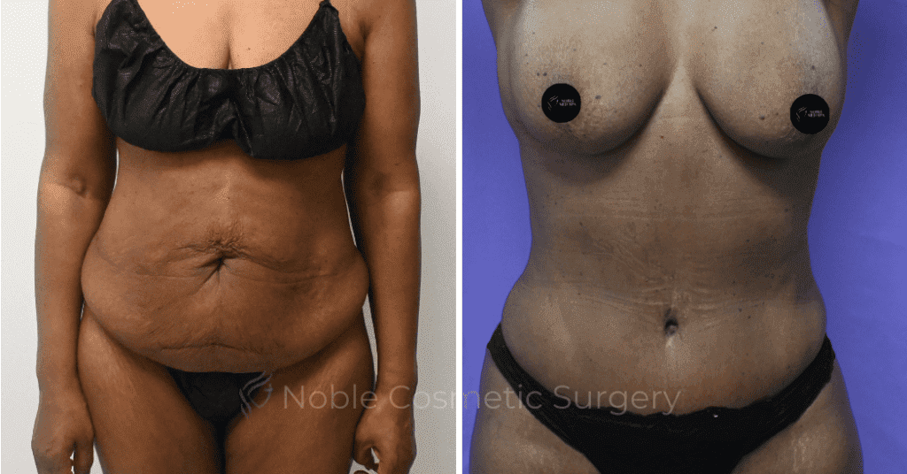 TUMMY TUCK CASE 10375