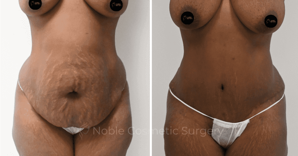 TUMMY TUCK CASE 10563