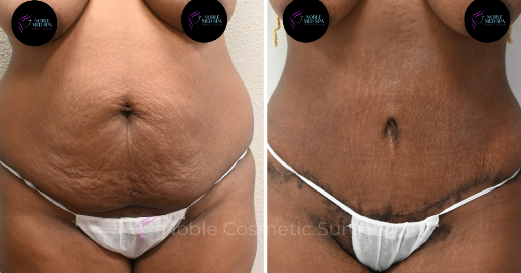 TUMMY TUCK CASE 13859