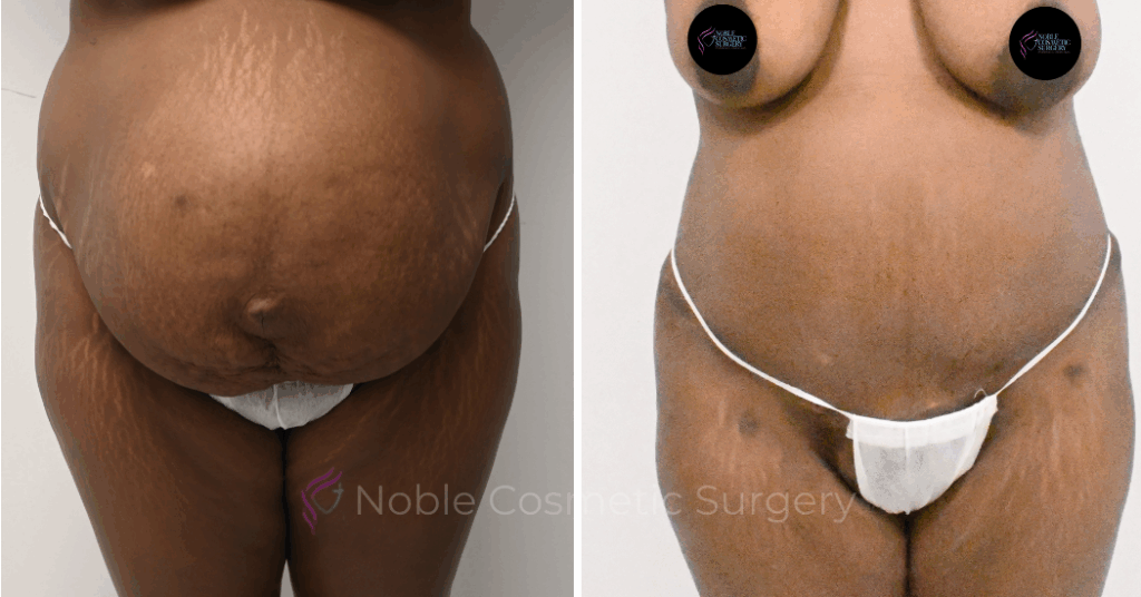 TUMMY TUCK CASE 11379