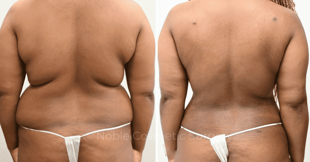 LIPOSUCTION CASE 13859