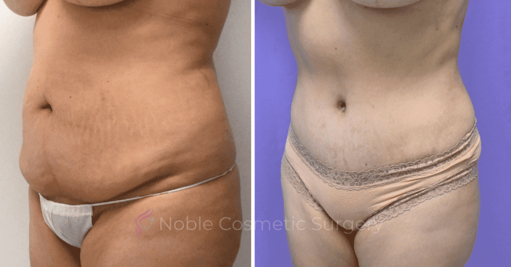 tummy reduction surgery