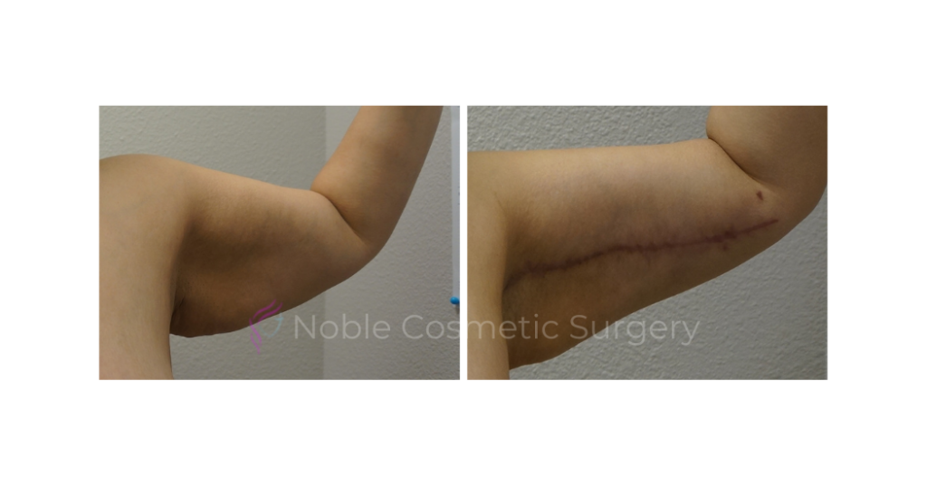 ARM LIFT CASE 17203
