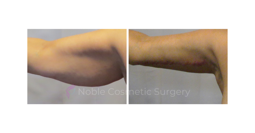 ARM LIFT CASE 19050