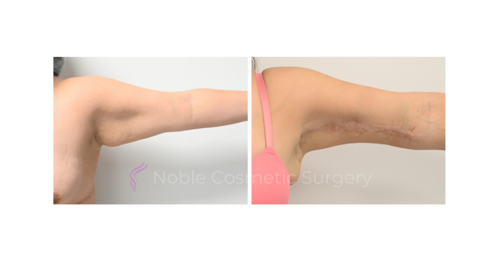 ARM LIFT CASE 15380