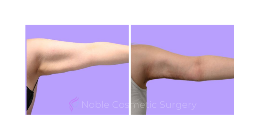 ARM LIFT CASE 19182